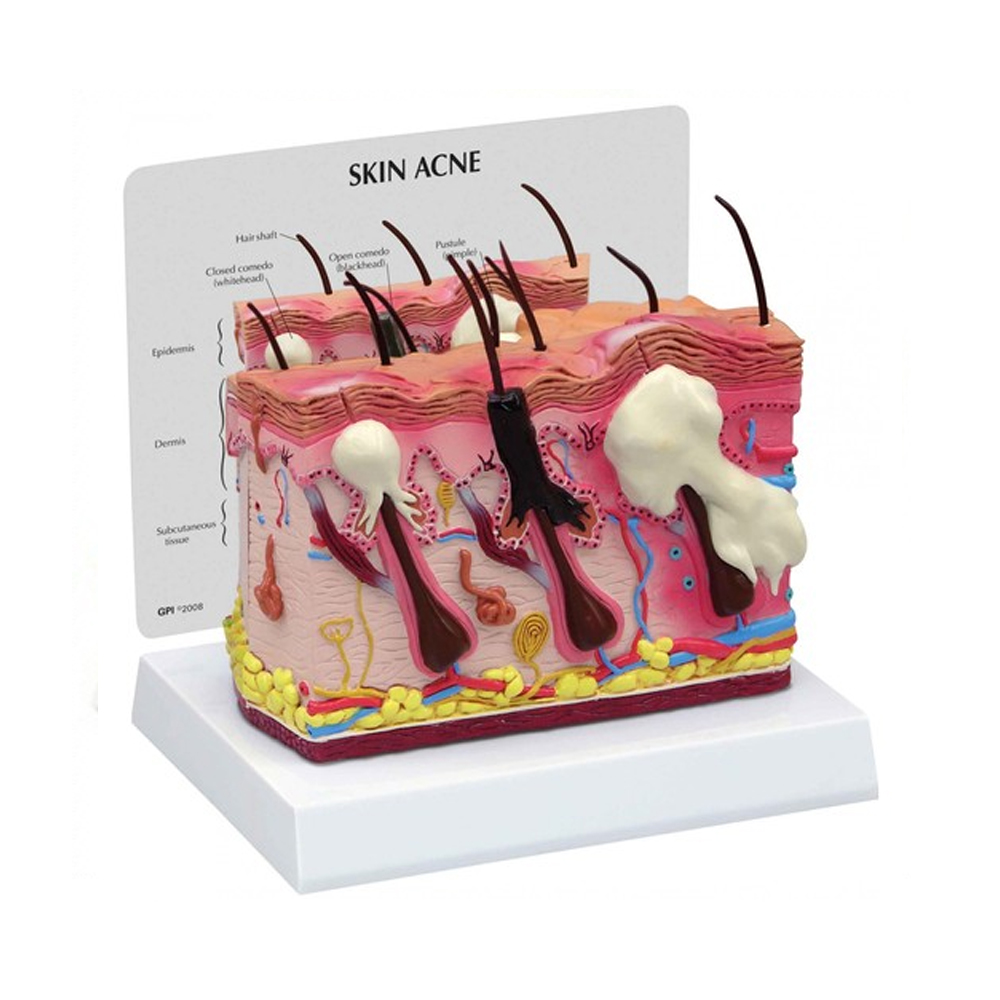 인체 내부 피부 모형 정상 여드름 G3751